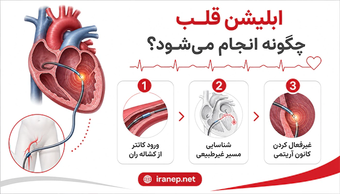 مراحل انجام ابلیشن قلب با کاتتر برای درمان مسیرهای غیرطبیعی قلب