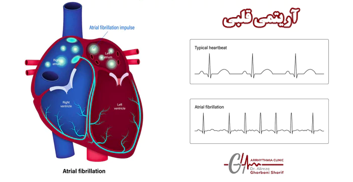 ضربان قلب در آریتمی