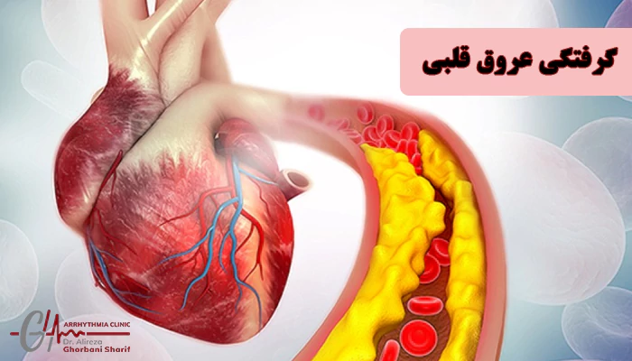 گرفتگی عروق قلبی